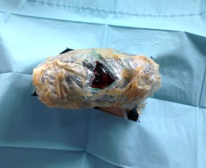 First incision (oops), Twizzler™ twists, Good and Plenty™, Tic Tacs™, licorice gum, gel medium, polyurethane, bubble wrap, chicken wire, plastic wrap, wood glue, surgical drape and wood, 18 x 24 x 6", 2014